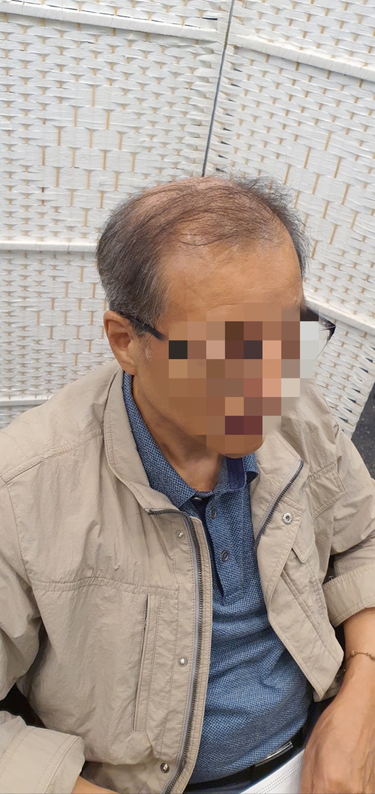 김호증모가발by헤어리서치 이미지