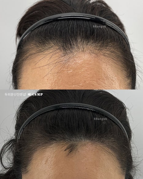 장헤어라인 이미지