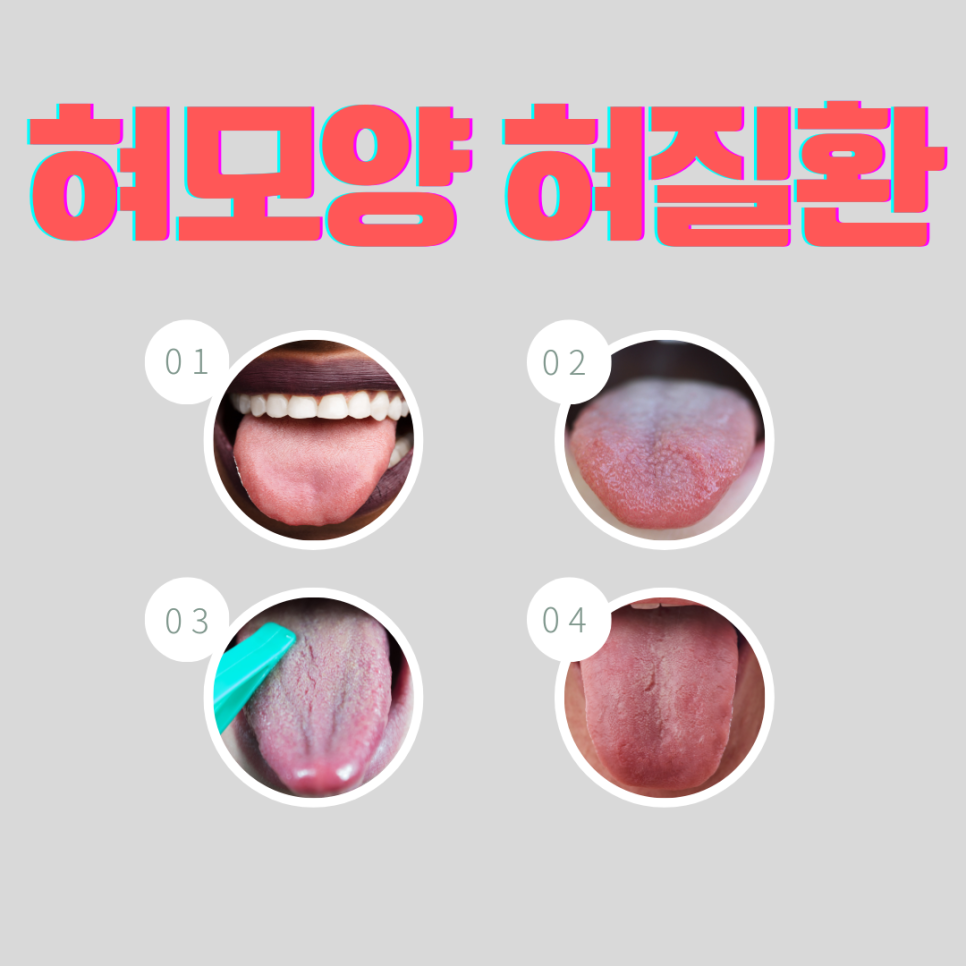 혀 모양 혀질환 5가지! 건강 상태 확인하는 방법 : 네이버 블로그