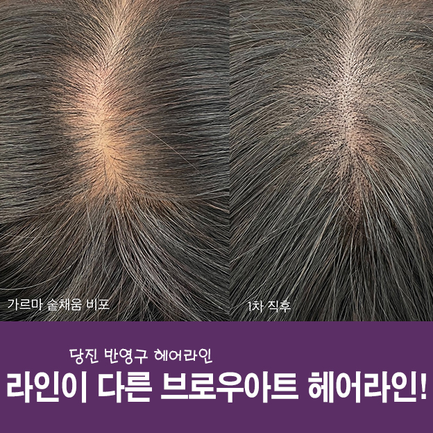 바다헤어라인 이미지