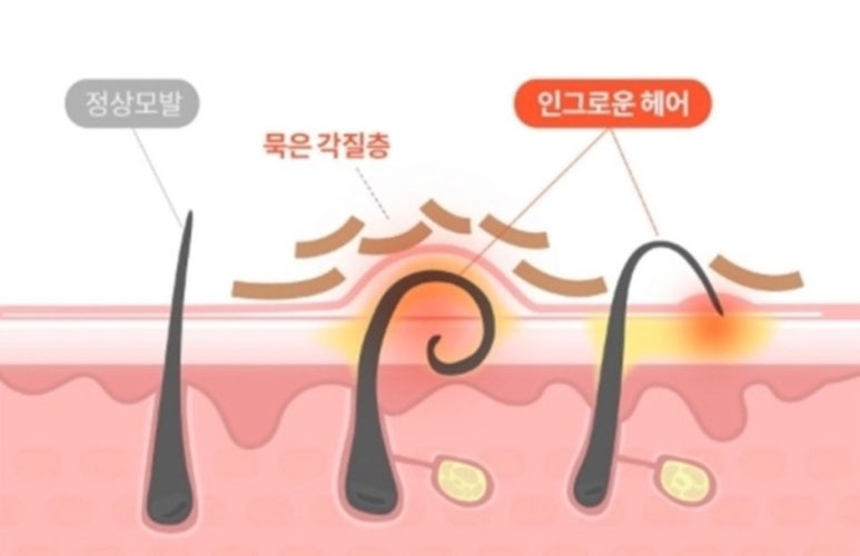란헤어 이미지