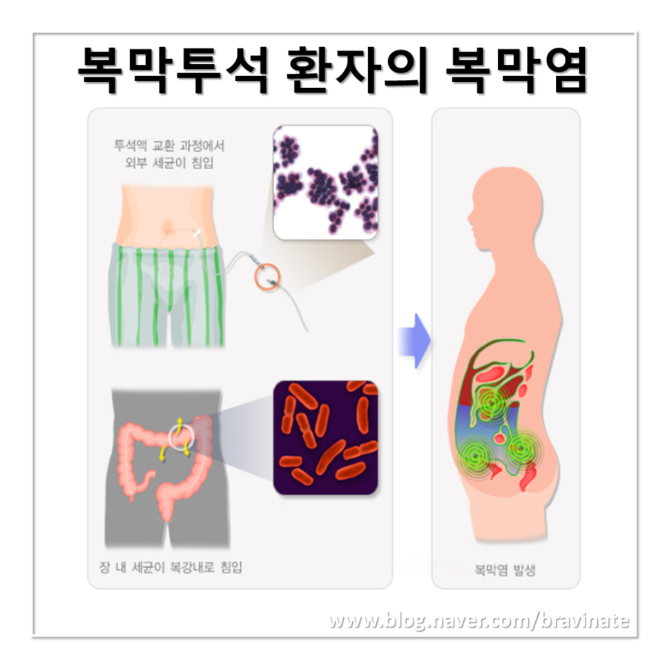 복막투석 혈액투석 치료, 검사, 준비, 방법, 도관, 종류, 복막염, 교환, 부작용, 주의사항, 예방, 관리 : 네이버 블로그