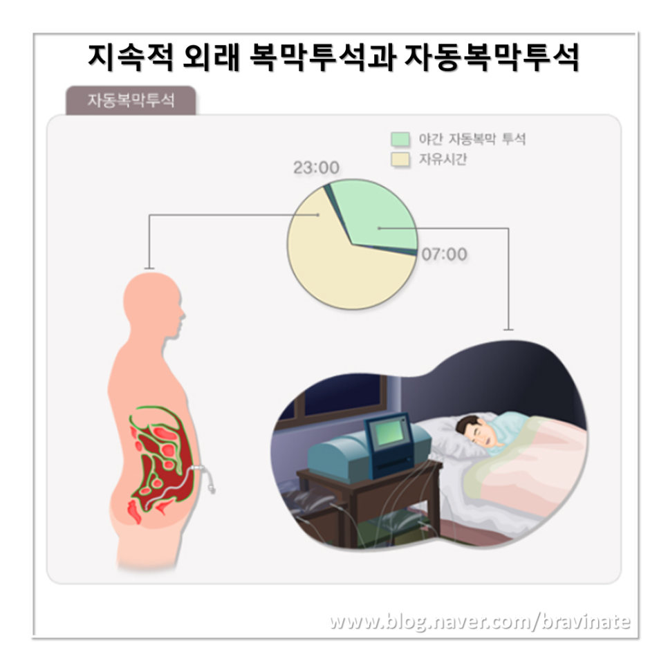 복막투석 혈액투석 치료, 검사, 준비, 방법, 도관, 종류, 복막염, 교환, 부작용, 주의사항, 예방, 관리 : 네이버 블로그