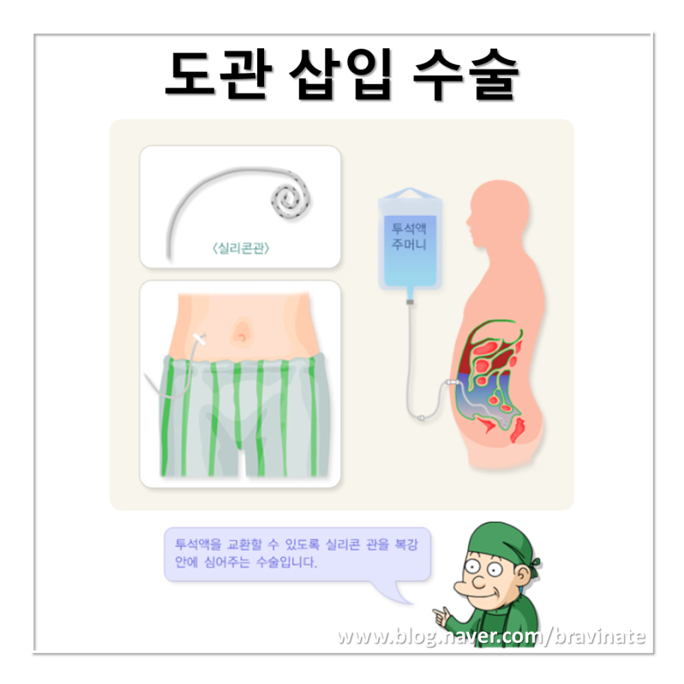 복막투석 혈액투석 치료, 검사, 준비, 방법, 도관, 종류, 복막염, 교환, 부작용, 주의사항, 예방, 관리 : 네이버 블로그