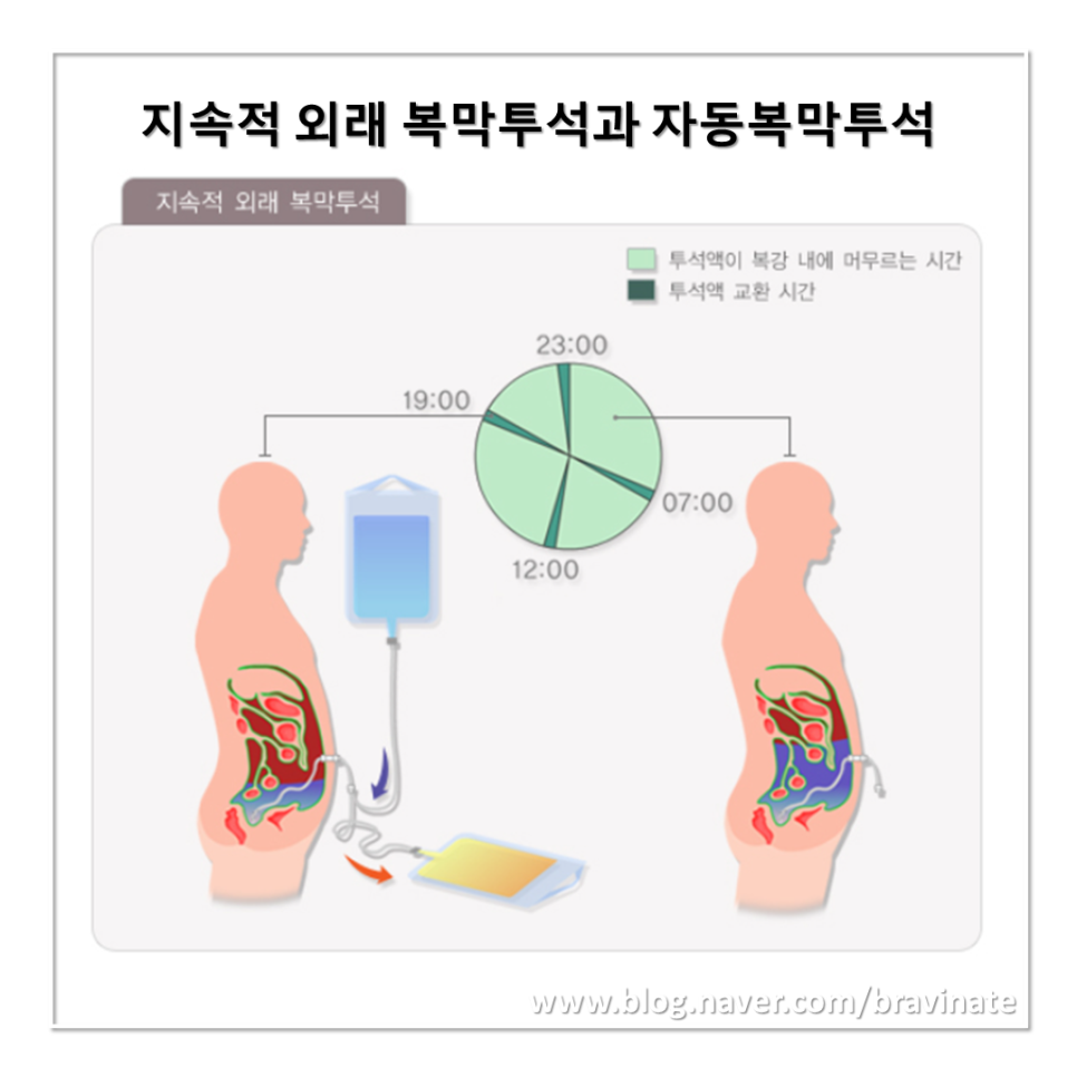 복막투석 혈액투석 치료, 검사, 준비, 방법, 도관, 종류, 복막염, 교환, 부작용, 주의사항, 예방, 관리 : 네이버 블로그