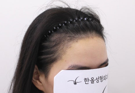 더헤어라인성형외과의원 이미지