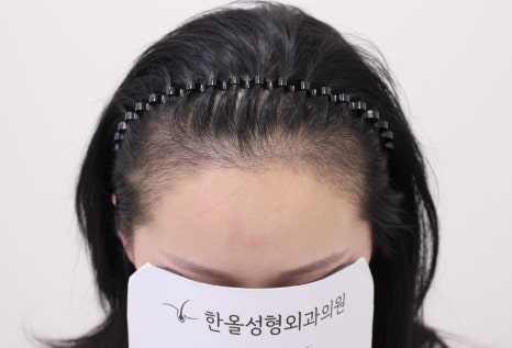 더헤어라인성형외과의원 이미지