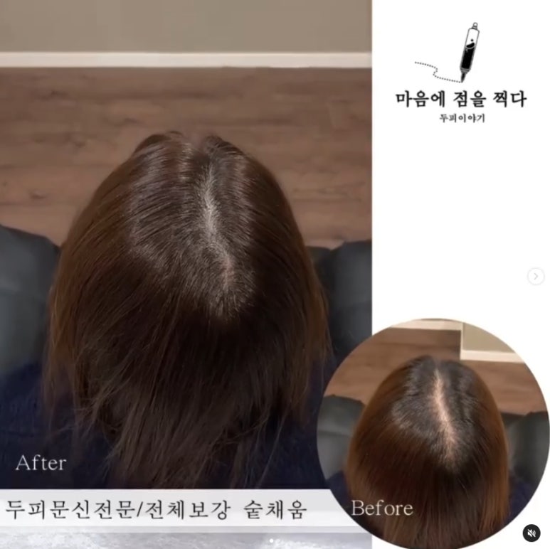 마음에점을찍다두피SMP 이미지