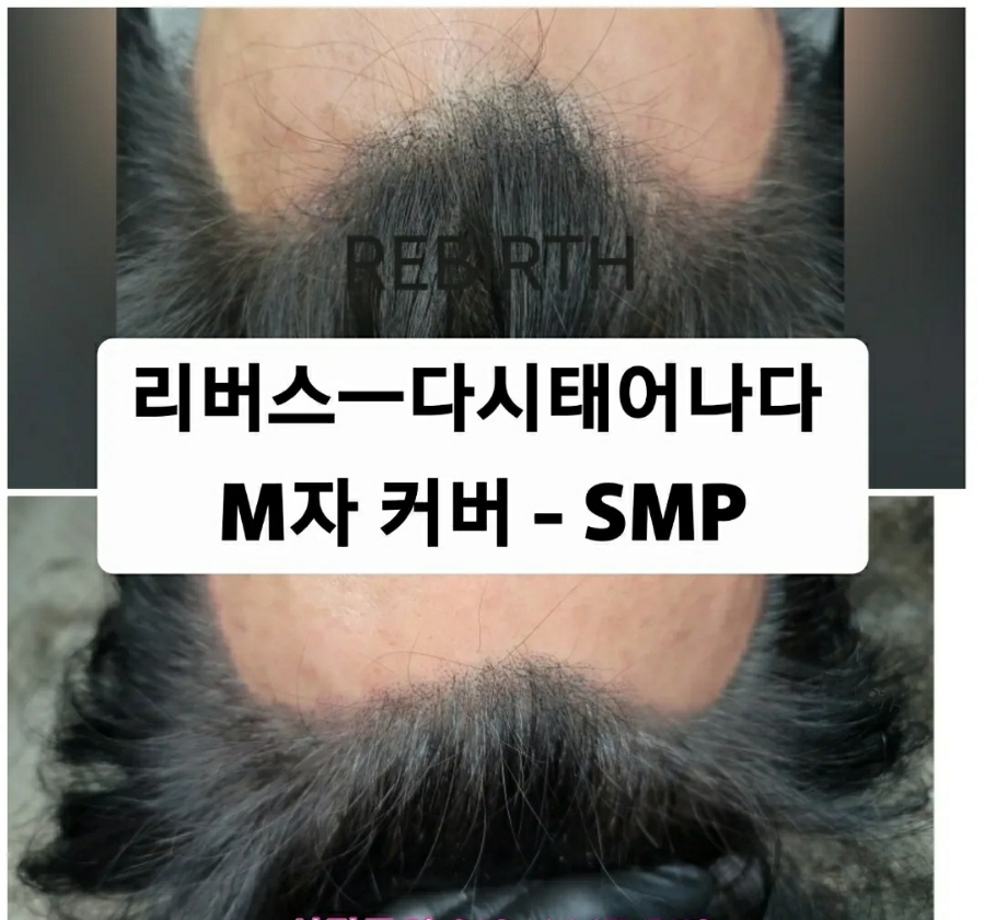 탈모응급실 리버스-다시태어나다 이미지