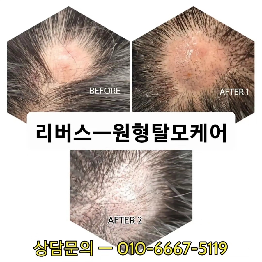 탈모응급실 리버스-다시태어나다 이미지
