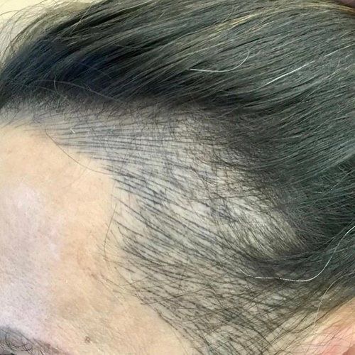 선헤어라인 이미지