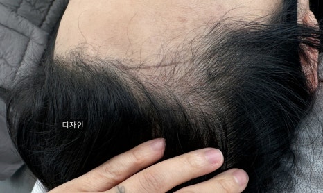 오즈헤어라인 이미지
