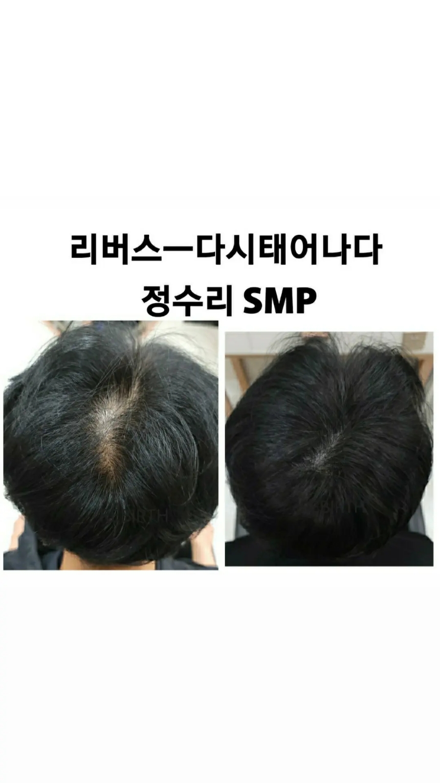 탈모응급실 리버스-다시태어나다 이미지