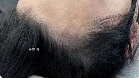오즈헤어라인 이미지