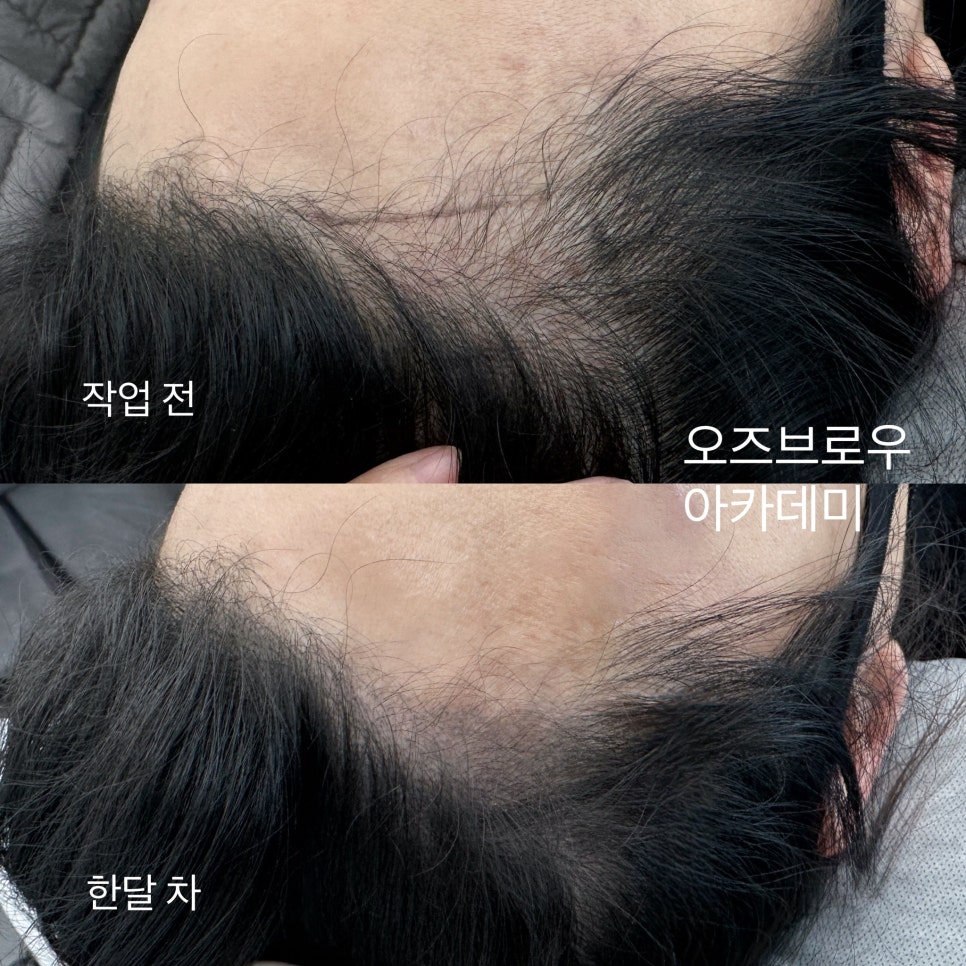 오즈헤어라인 이미지