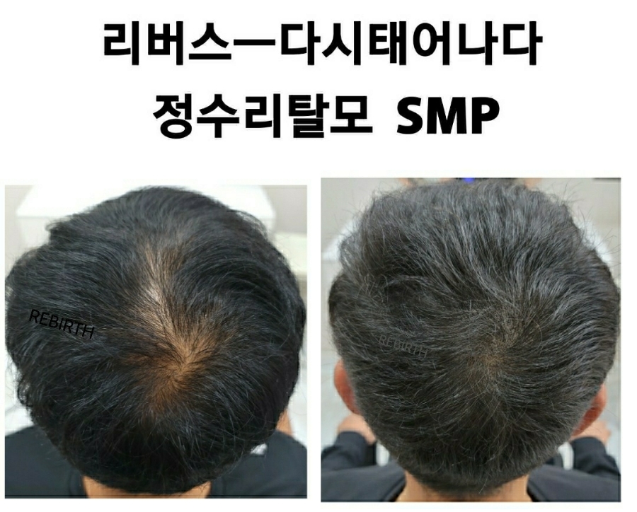 탈모응급실 리버스-다시태어나다 이미지