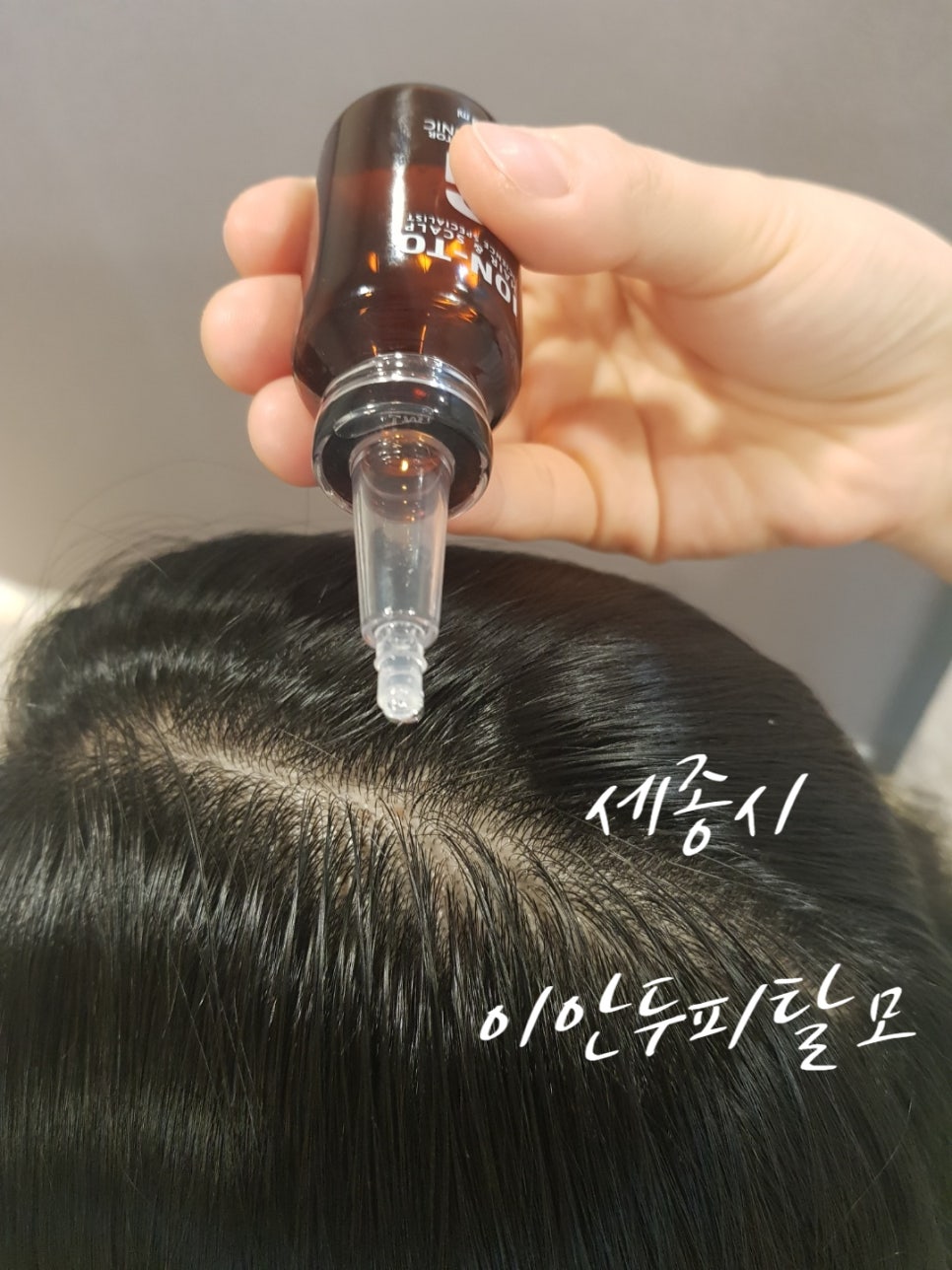 이안두피탈모 이미지