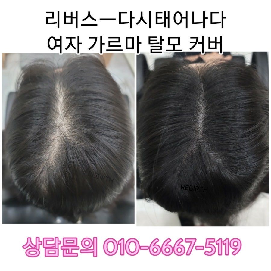 탈모응급실 리버스-다시태어나다 이미지