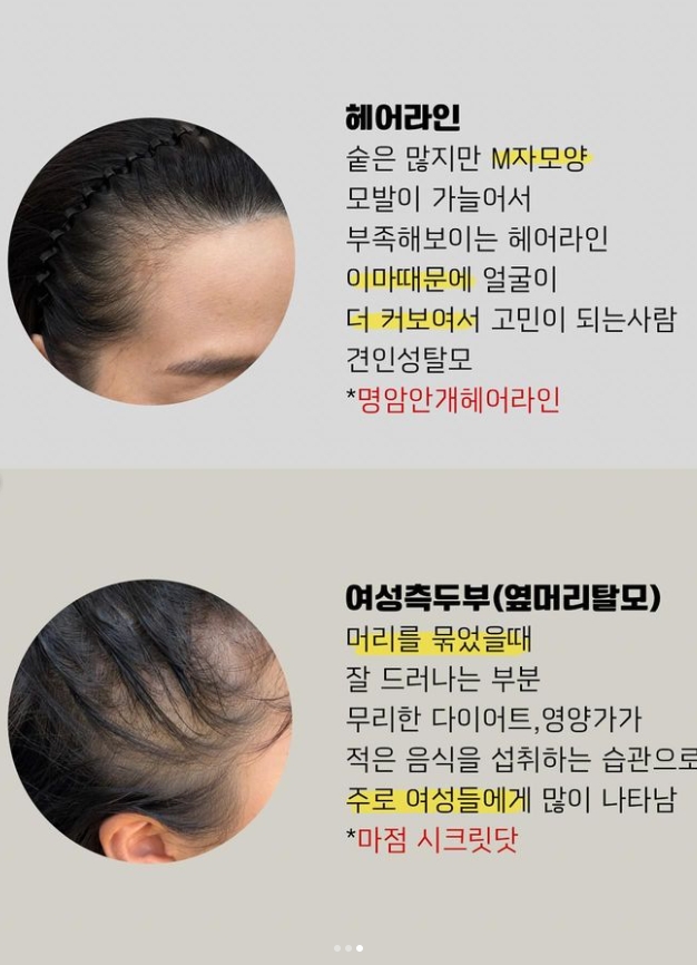 마음에점을찍다두피SMP 이미지