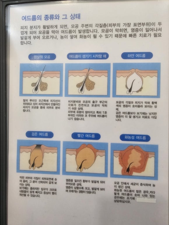 양산 여드름 관리 남부동 피지 모공 재생관리 잘하는 곳 '여드름살롱'