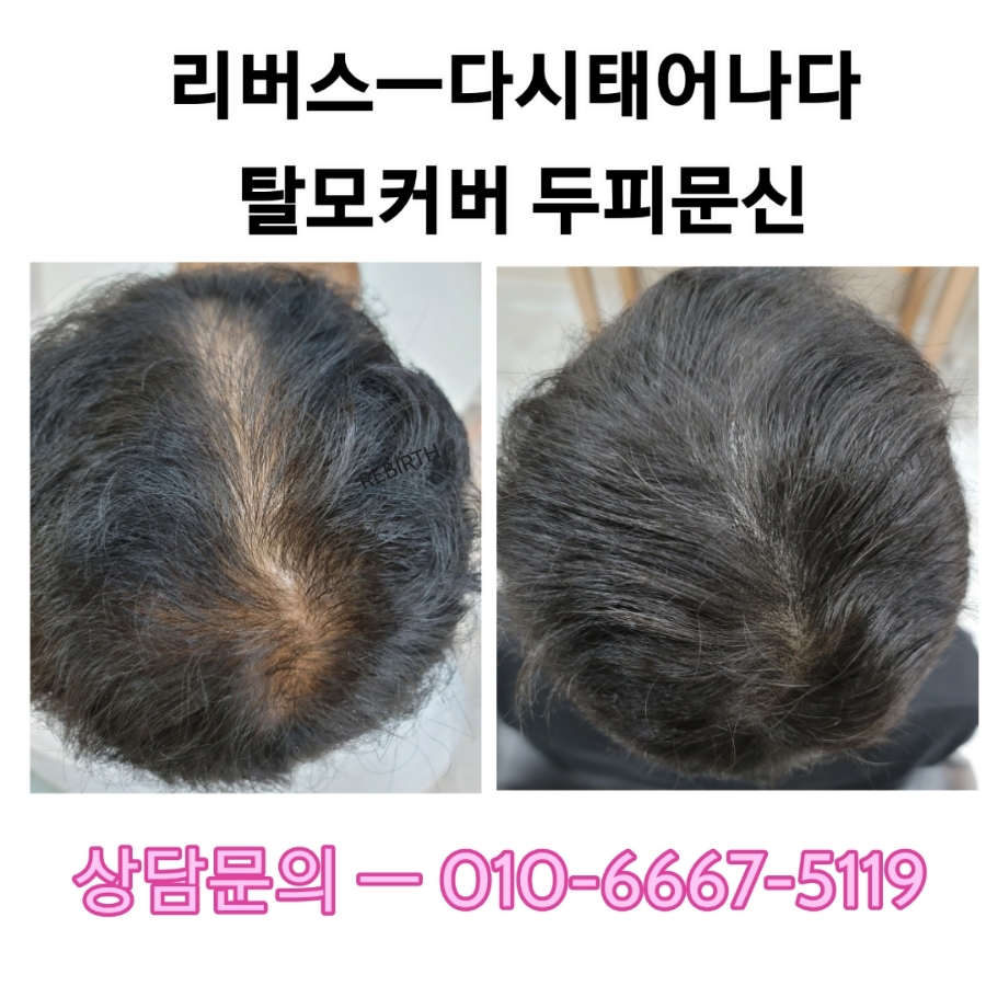 탈모응급실 리버스-다시태어나다 이미지