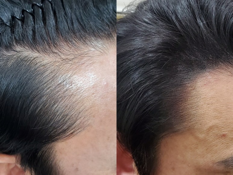 이지헤어라인 이미지