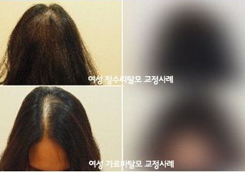 모발을 채우다 이미지