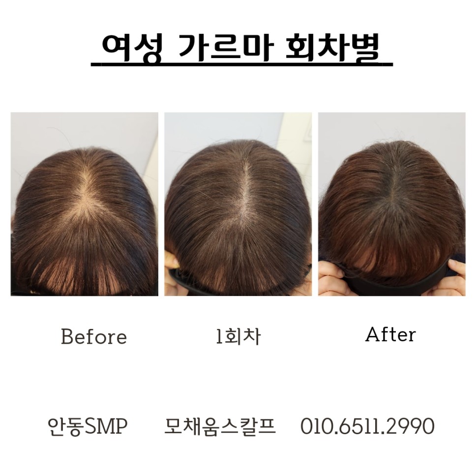 두피움 이미지