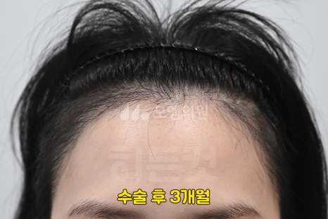 중앙헤어라인 이미지