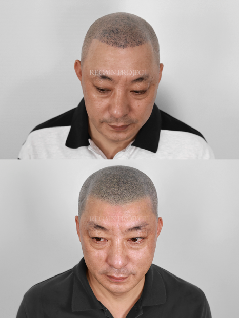 조헤어라인 이미지
