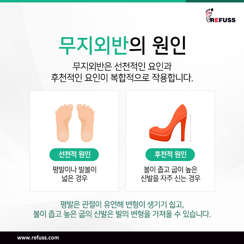 레푸스 이미지