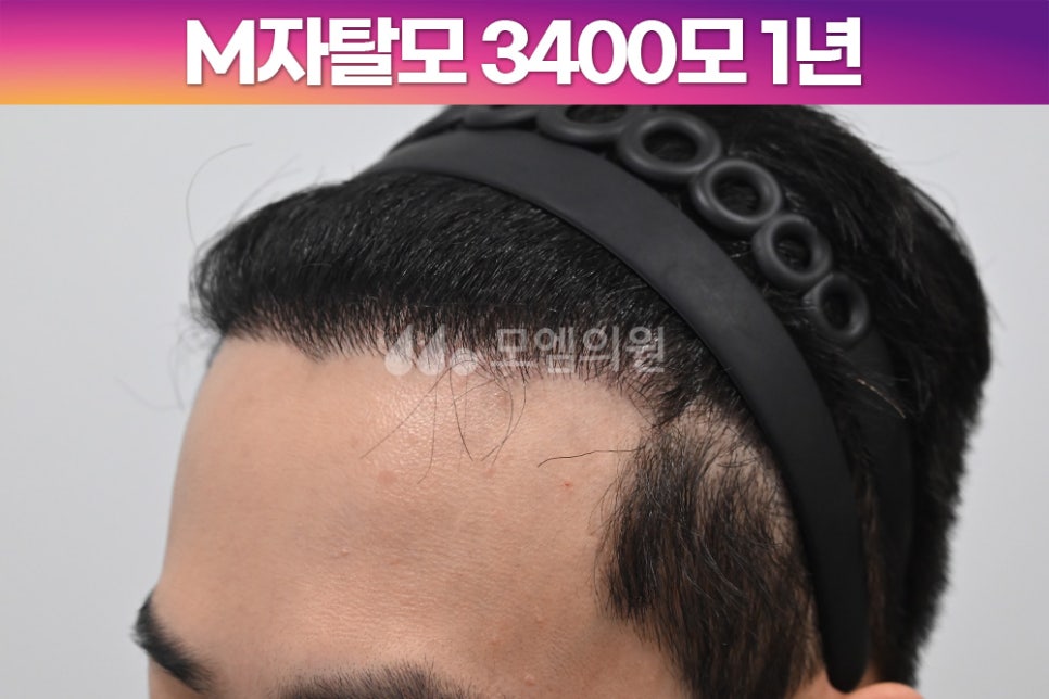 중앙헤어라인 이미지