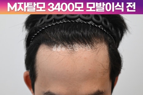 중앙헤어라인 이미지