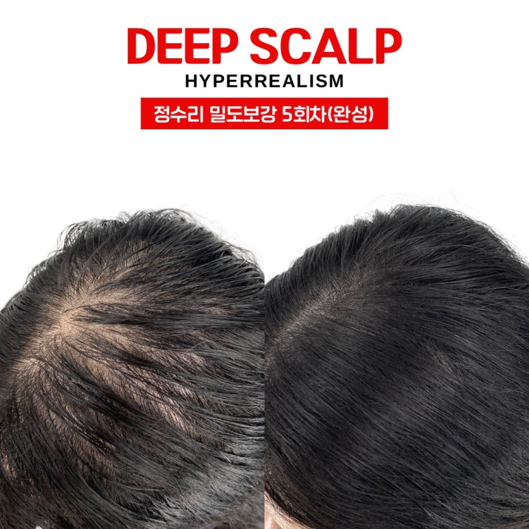 본스칼프 이미지