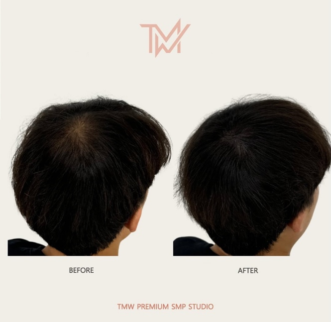 탈모왕수원 이미지