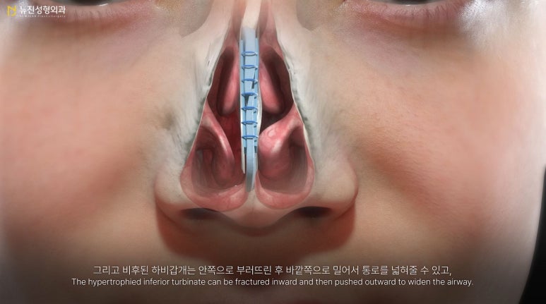 뉴진성형외과 이미지