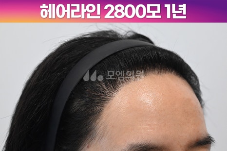 중앙헤어라인 이미지