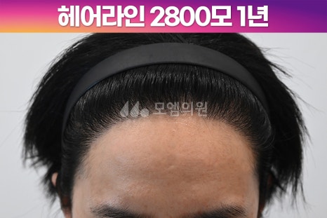 중앙헤어라인 이미지