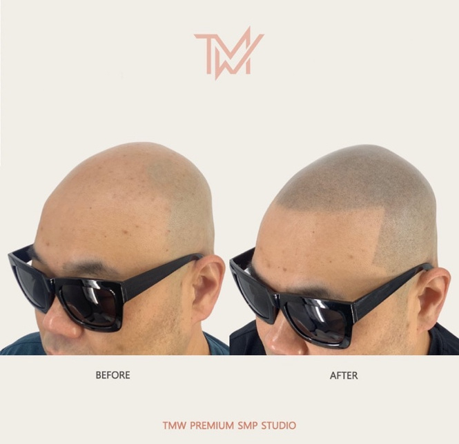 탈모왕수원 이미지