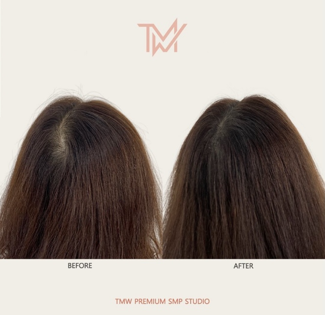 탈모왕수원 이미지