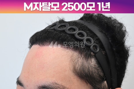헤어라인 이미지