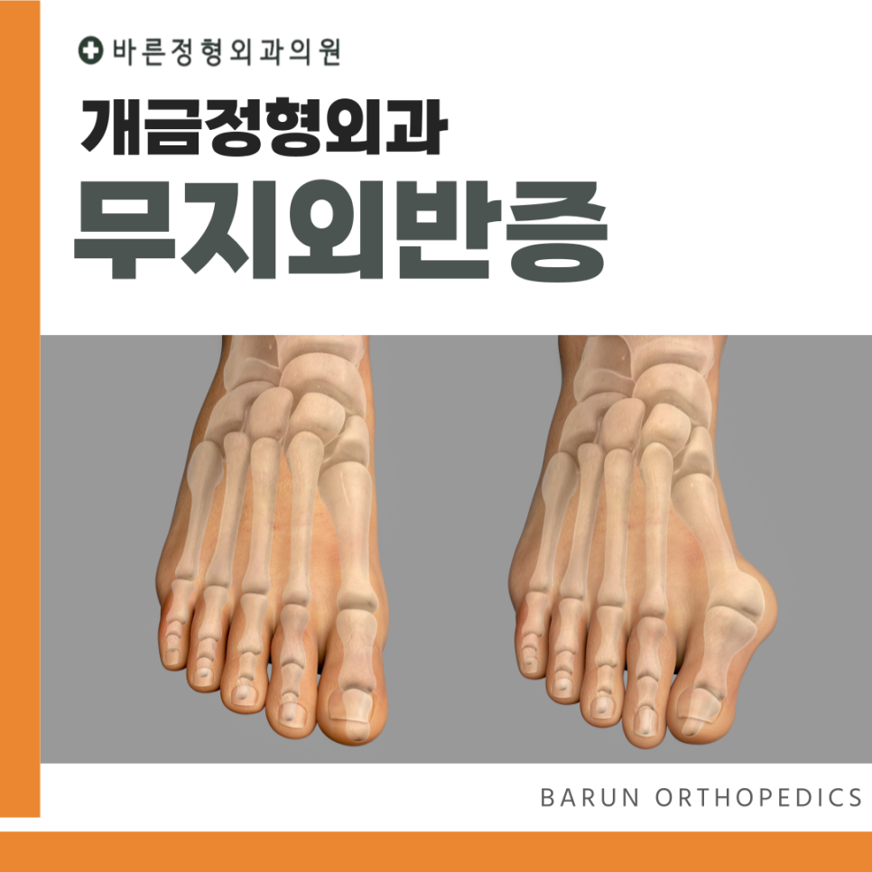 개금신발 이미지