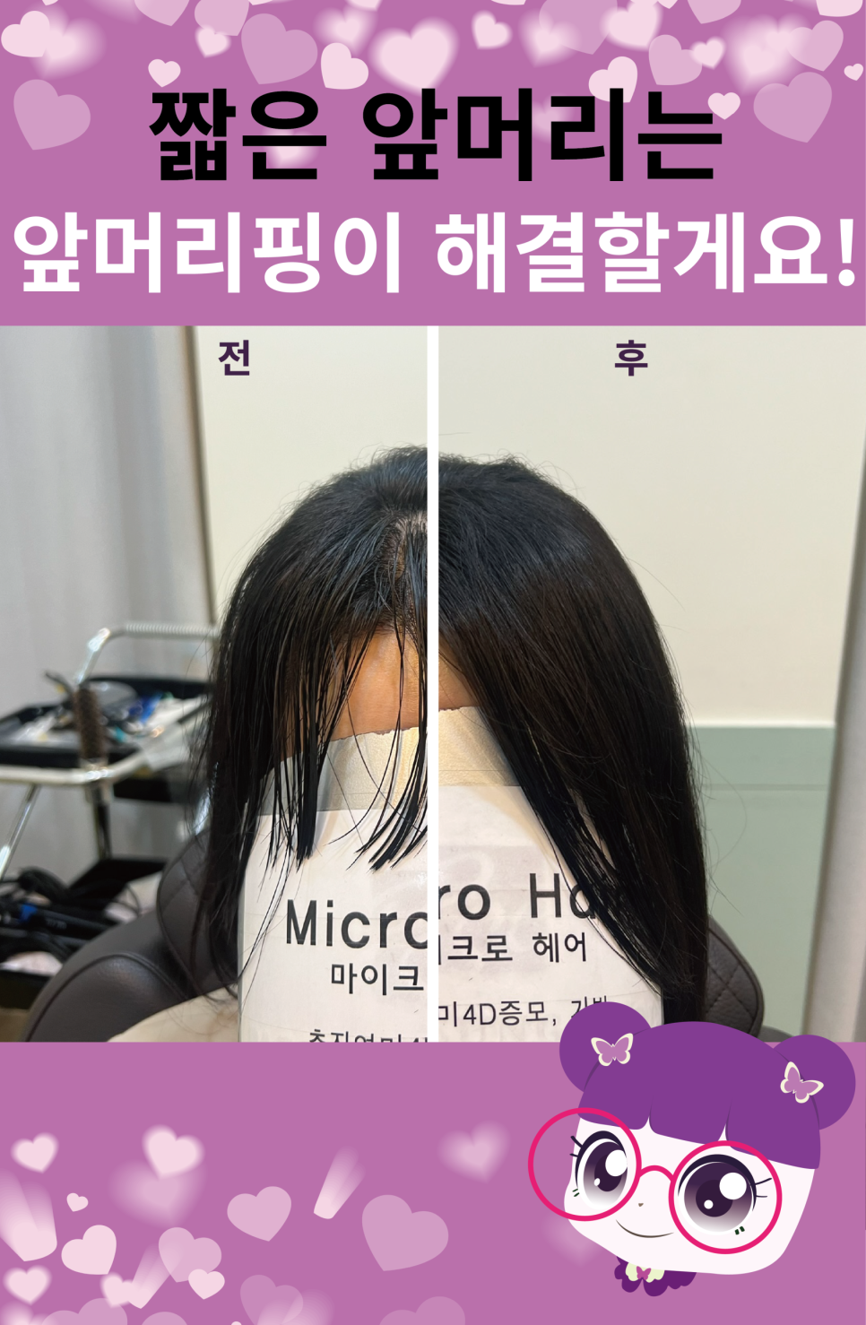 마이크로헤어증모 이미지