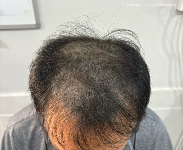 돕스칼프 이미지