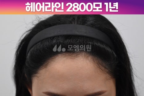 중앙헤어라인 이미지