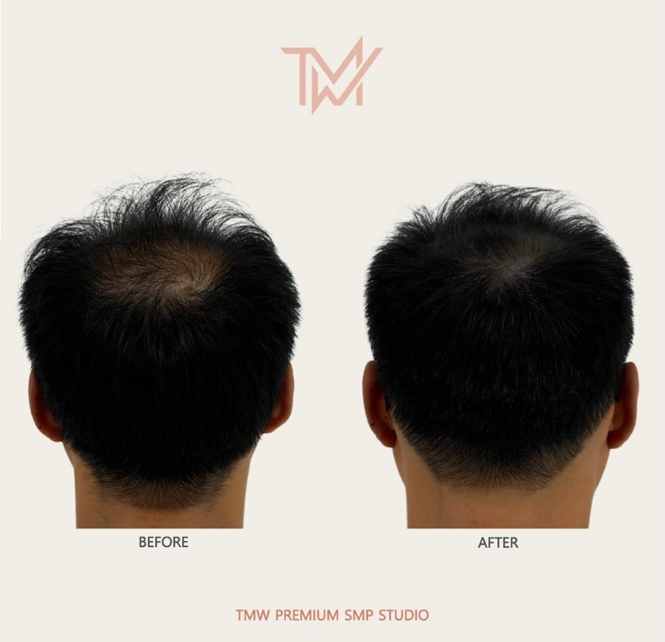 탈모왕수원 이미지