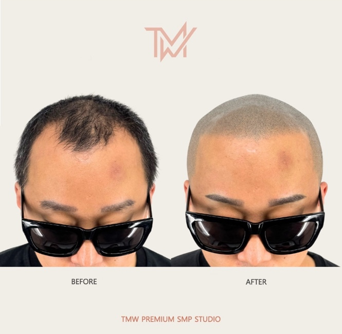 탈모왕수원 이미지