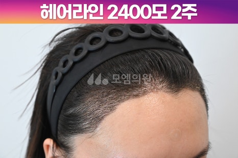 중앙헤어라인 이미지