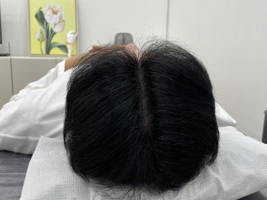 림스칼프 이미지