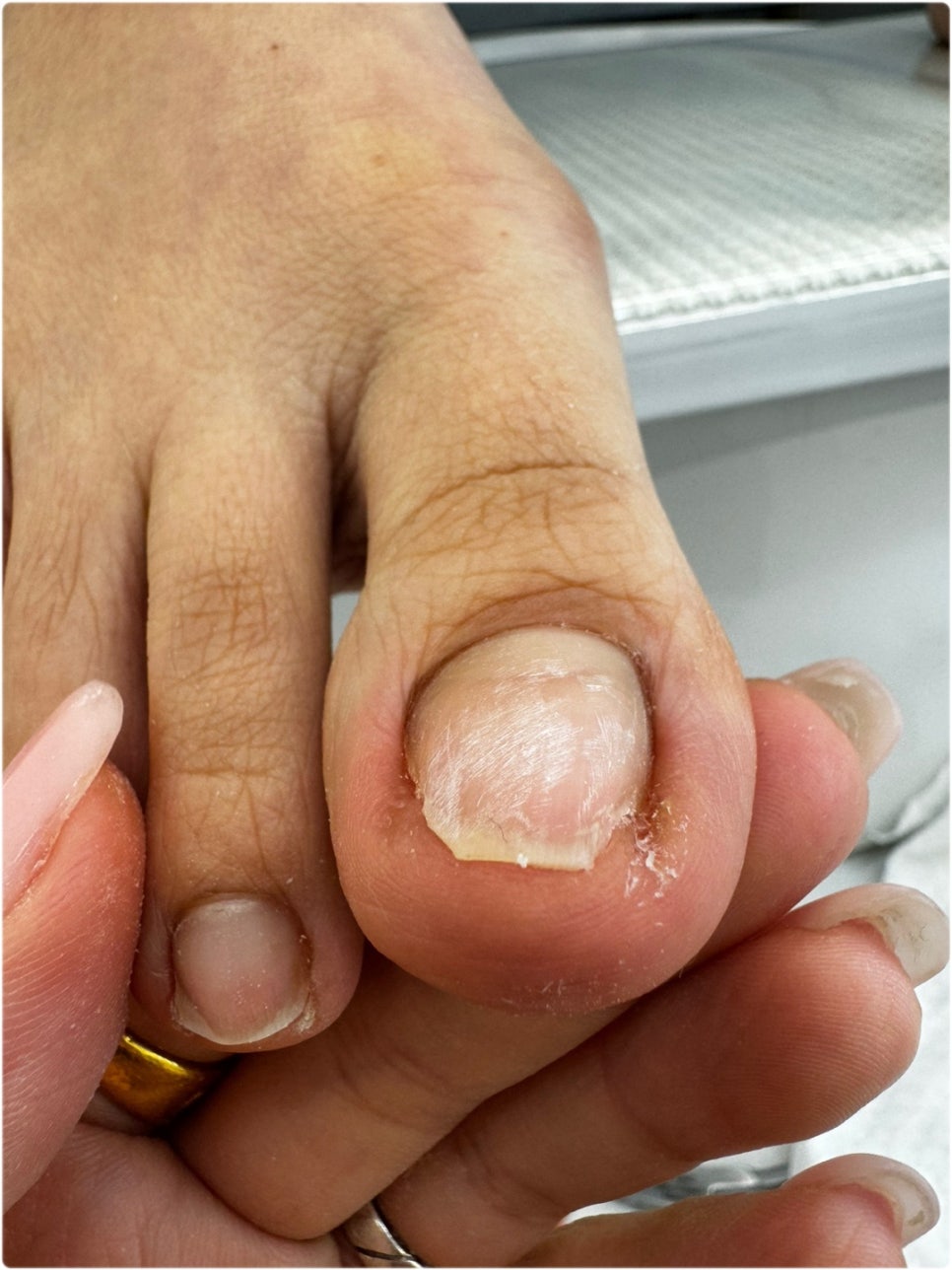 무드비네일닥터아이티엔내성발톱무좀발각질 이미지